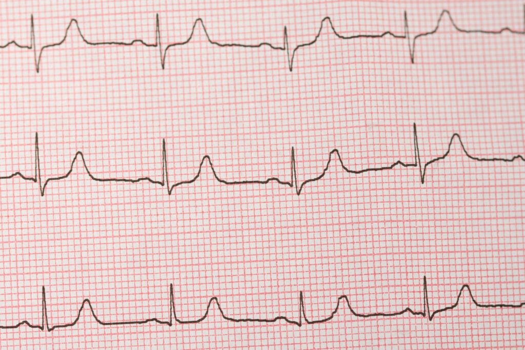 What Does an ECG Test Tell You?
