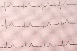 What Does an ECG Test Tell You?