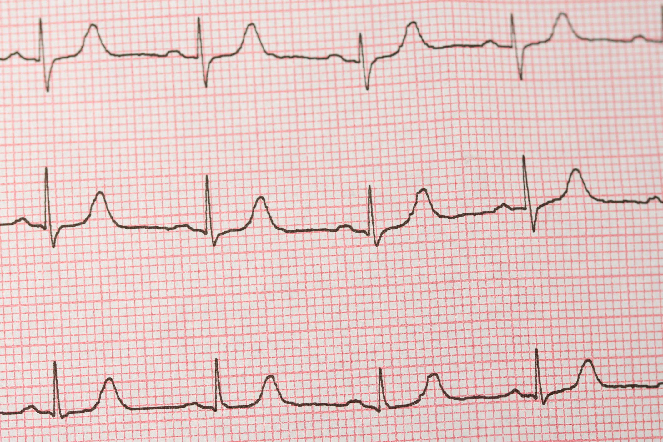 What Does an ECG Test Tell You?